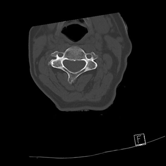 Bilateral occipital condyle fractures (type 3) (Radiopaedia 87672-104086 Axial bone window 33).jpg
