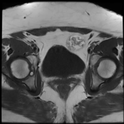File:Bilateral ovarian dermoid cysts (Radiopaedia 90152-107338 Axial T1 16).jpg