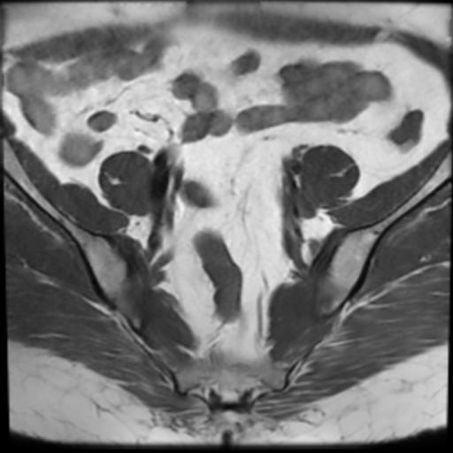 File:Bilateral ovarian dermoid cysts (Radiopaedia 90152-107338 Axial T1 6).jpg