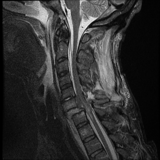 File:Bilateral perched facets with cord injury (Radiopaedia 45587-49714 Sagittal STIR 7).jpg