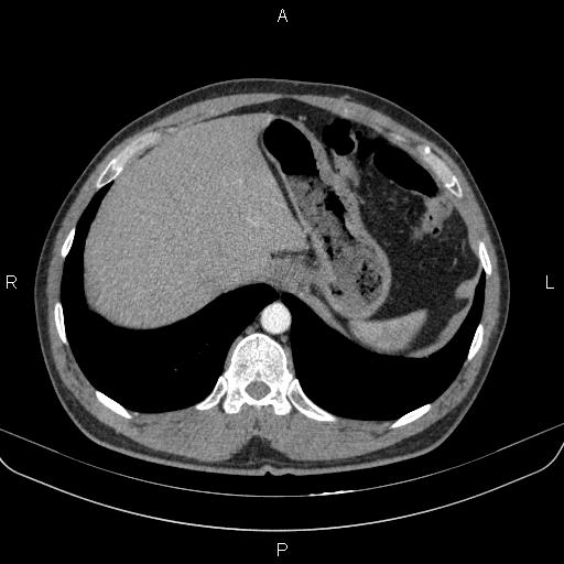 Bilateral pulmonary AVM (Radiopaedia 83134-97505 A 65).jpg