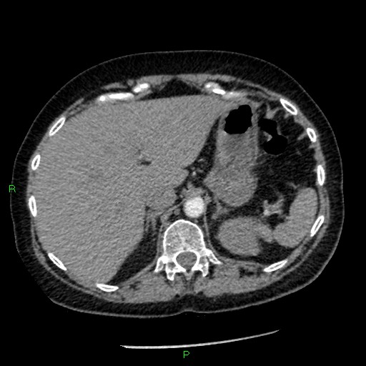 Bilateral pulmonary emboli (Radiopaedia 32700-33669 Axial C+ CTPA 103).jpg