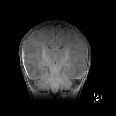 File:Bilateral subdural hemorrhage and parietal skull fracture (Radiopaedia 26058-26190 Coronal T1 31).png