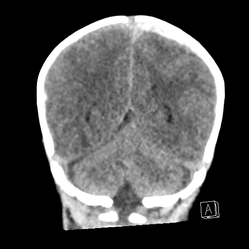 File:Bilateral subdural hemorrhage and parietal skull fracture (Radiopaedia 26058-26192 Coronal non-contrast 20).png