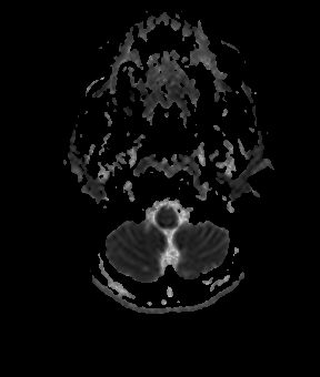 File:Bilateral thalamic gliomata (Radiopaedia 42538-45664 Axial ADC 3).jpg