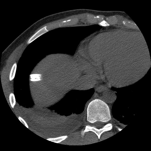 File:Bile leak from liver traumatic laceration (Radiopaedia 63463-72077 Axial Biliscopin 4).jpg