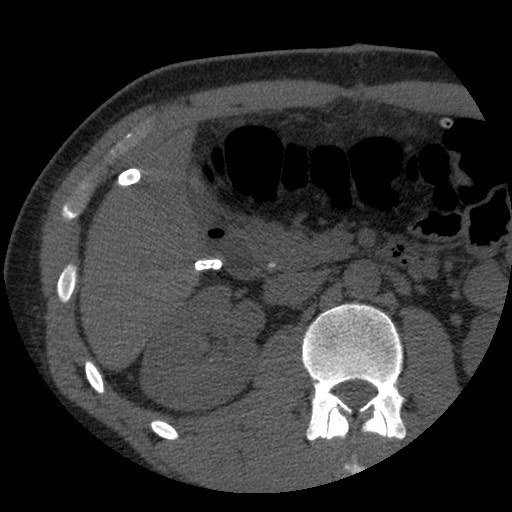 Bile leak from liver traumatic laceration (Radiopaedia 63463-72077 Axial Biliscopin 60).jpg