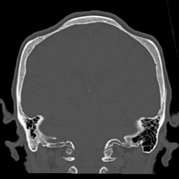 Biparietal osteodystrophy (Radiopaedia 46109-50463 Coronal bone window 69).jpg