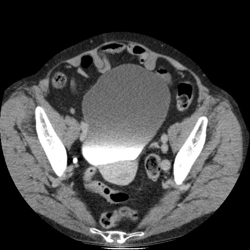 Bladder tumor detected on trauma CT (Radiopaedia 51809-57609 C 114).jpg