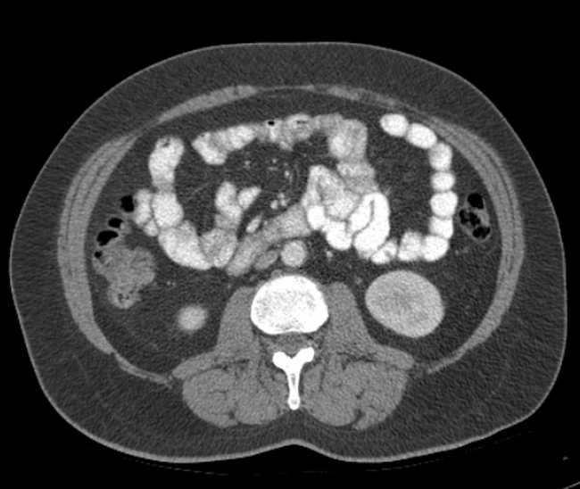 File:Bleeding duodenal ulcer and adenomyomatosis of gallbladder (Radiopaedia 61834-69861 A 63).jpg