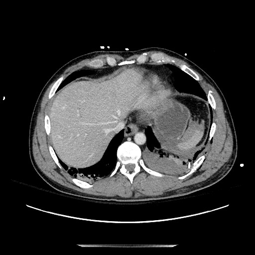 Blunt abdominal trauma with solid organ and musculoskelatal injury with active extravasation (Radiopaedia 68364-77895 A 16).jpg