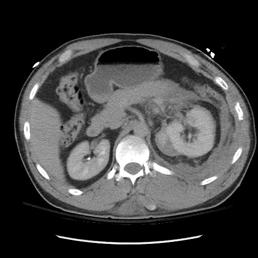 Blunt abdominal trauma with solid organ and musculoskelatal injury with active extravasation (Radiopaedia 68364-77895 Axial C+ delayed 47).jpg
