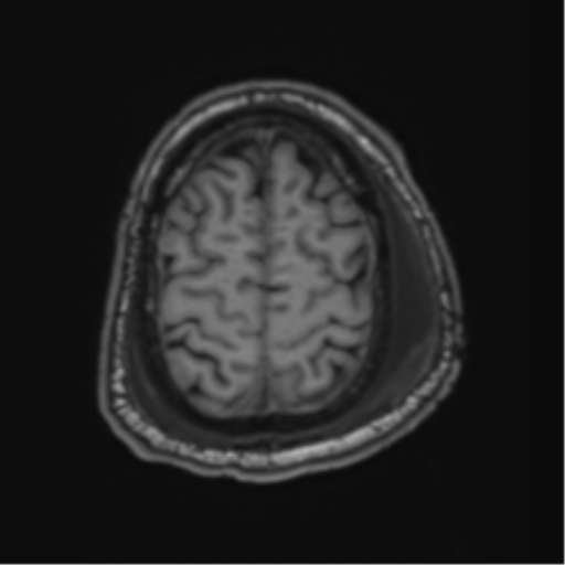 File:Blunt cerebrovascular injury (Radiopaedia 53682-59745 Axial T1 27).png