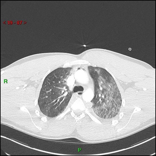 Blunt thoracic trauma (Radiopaedia 73454-84221 Axial lung window 32).jpg