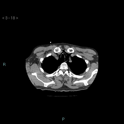 Boerhaave syndrome (Radiopaedia 27683-27897 Axial non-contrast 18).jpg