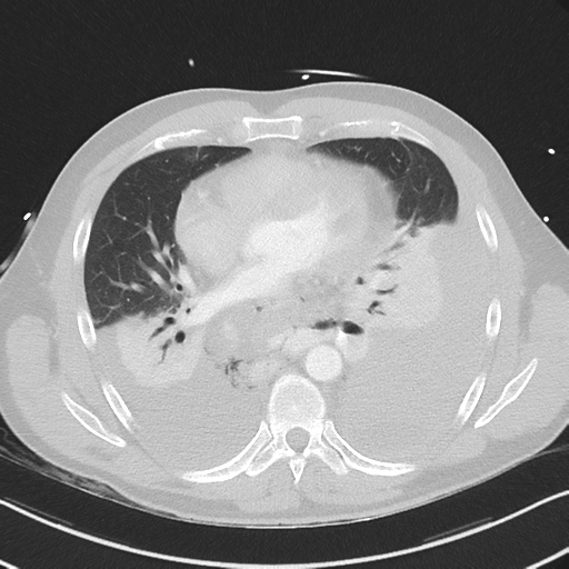 Boerhaave syndrome (Radiopaedia 39382-41661 Axial lung window 33).png
