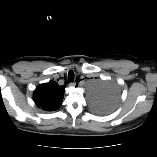 Boerhaave syndrome (Radiopaedia 59796-67310 Axial liver window 13).jpg