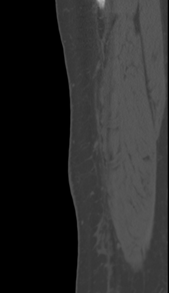 Bone metastasis - tibia (Radiopaedia 57665-64609 Sagittal bone window 21).jpg