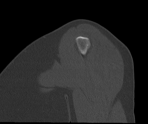 Bony Bankart and Hill-Sachs lesions (Radiopaedia 33622-34727 Sagittal bone window 12).png