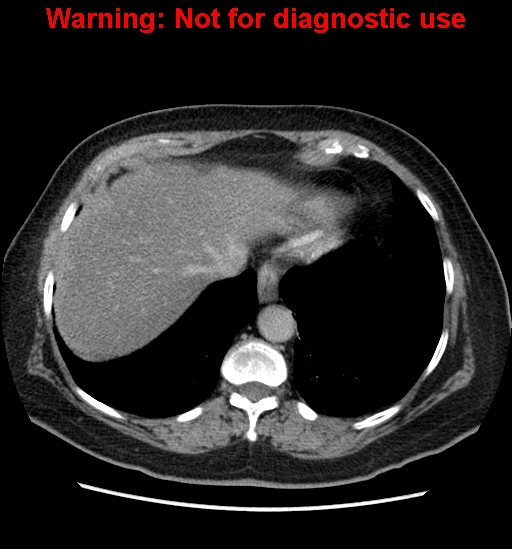 File:Bosniak renal cyst - type II (Radiopaedia 23404-23468 F 8).jpg