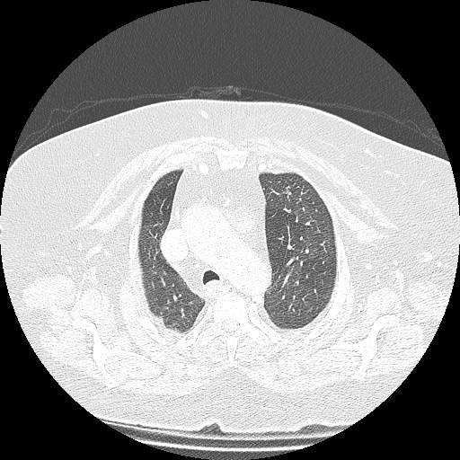 Bovine aortic arch - right internal mammary vein drains into the superior vena cava (Radiopaedia 63296-71875 Axial lung window 38).jpg