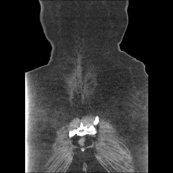 Bowel and splenic infarcts in acute lymphocytic leukemia (Radiopaedia 61055-68915 B 54).jpg