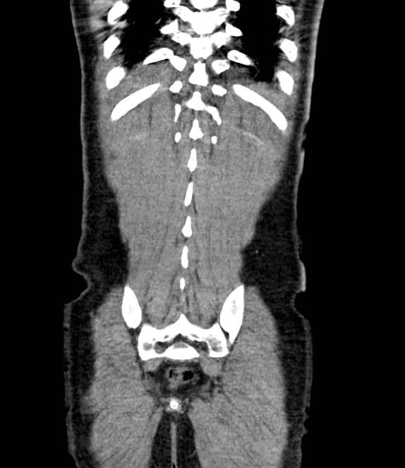 Bowel obstruction from colon carcinoma (Radiopaedia 22995-23028 C 67).jpg