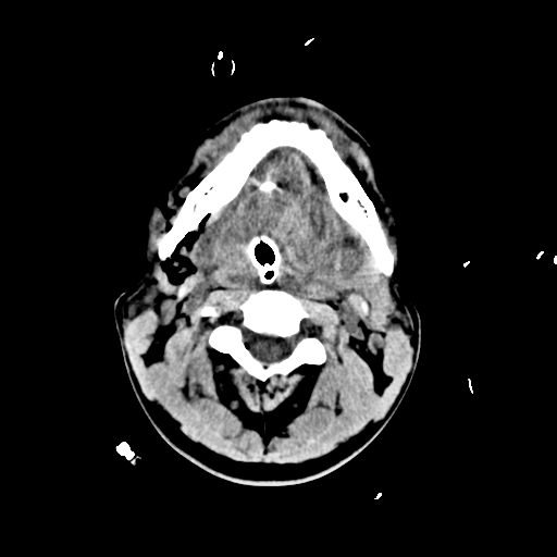 File:Brain contusions, internal carotid artery dissection and base of skull fracture (Radiopaedia 34089-35339 Axial non-contrast 7).png