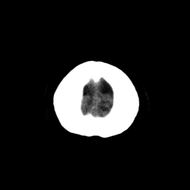 Brain cortical laminar necrosis (Radiopaedia 25822-25971 Axial non-contrast 48).jpg