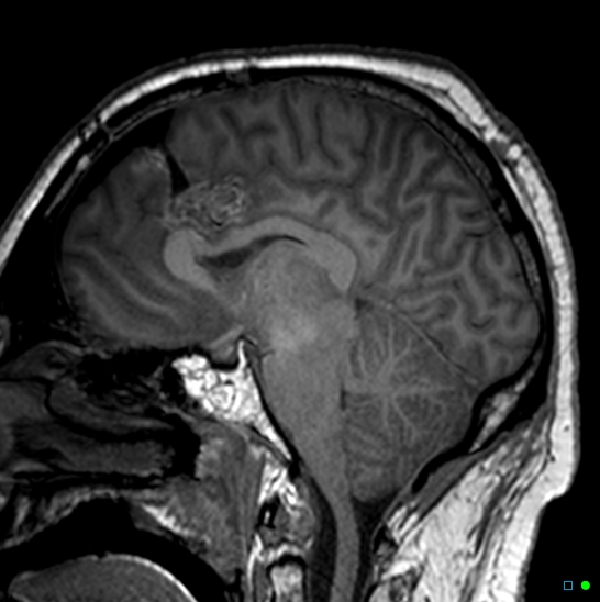 File:Brain death on MRI and CT angiography (Radiopaedia 42560-45689 Sagittal T1 29).jpg