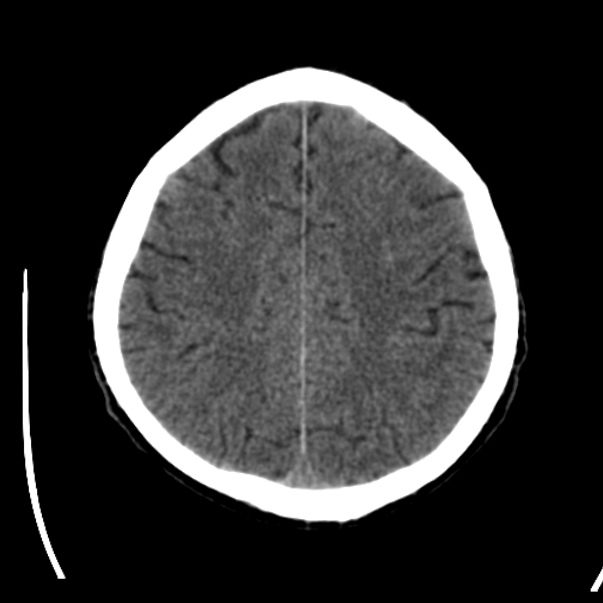 Brain metastases from lung cancer (Radiopaedia 24480-24781 Axial non-contrast 37).jpg