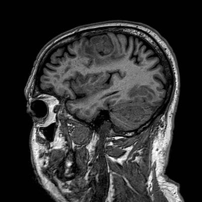 Brain metastases from lung cancer (Radiopaedia 83839-99028 Sagittal T1 97).jpg