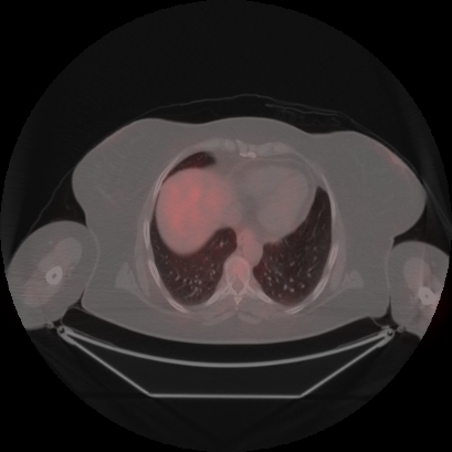 Brain metastasis (Radiopaedia 89847-106962 Axial lung window 45).jpg