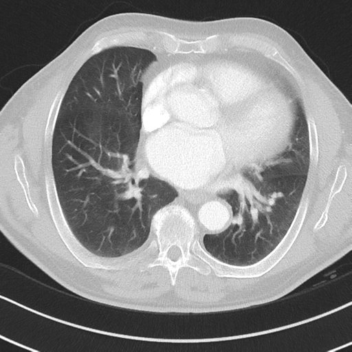 Brain metastasis (large cystic mass) (Radiopaedia 47497-52104 Axial lung window 27).png