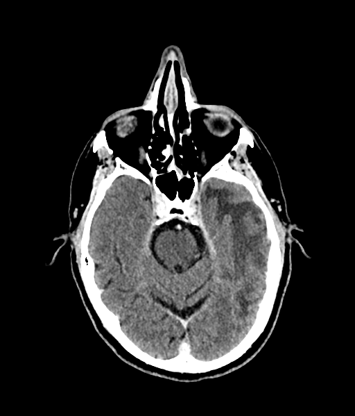 Brain metastasis (large cystic mass) (Radiopaedia 47497-52106 Axial C+ 24).png