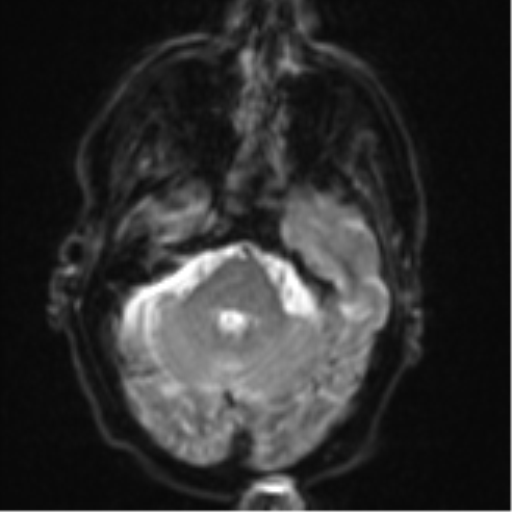 Brain metastasis (lung cancer) (Radiopaedia 48289-53179 Axial DWI 7).png