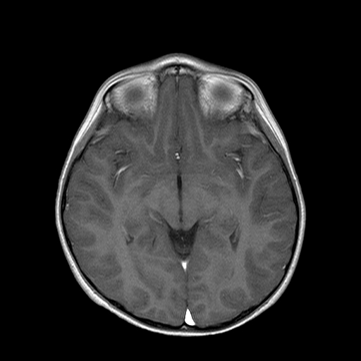 File:Brainstem ganglioglioma (Radiopaedia 10763-11224 Axial T1 C+ 3).jpg