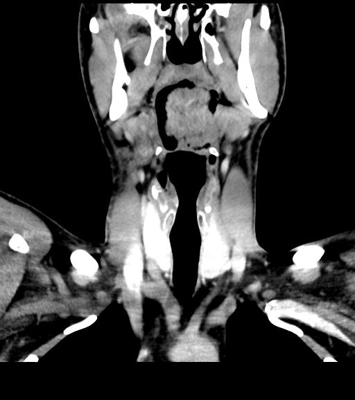 Branchial cleft cyst (Radiopaedia 31167-31875 Coronal C+ delayed 29).jpg