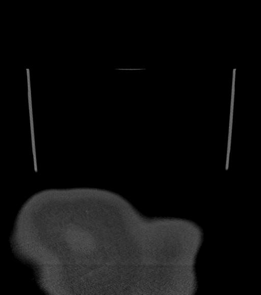Branchial cleft cyst (Radiopaedia 31167-31875 Coronal bone window 72).jpg