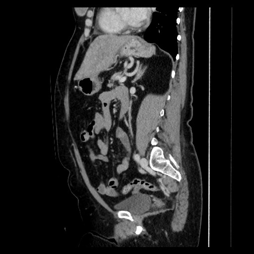 Breast cancer pseudocirrhosis with lobar invovlement (Radiopaedia 81080-94670 D 136).jpg
