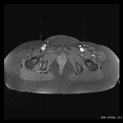 File:Broad ligament fibroid (Radiopaedia 49135-54241 Axial T1 fat sat 25).jpg