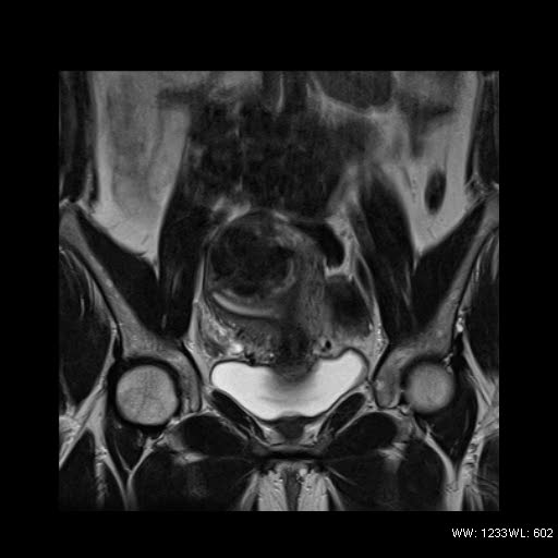 File:Broad ligament fibroid (Radiopaedia 49135-54241 Coronal T2 11).jpg