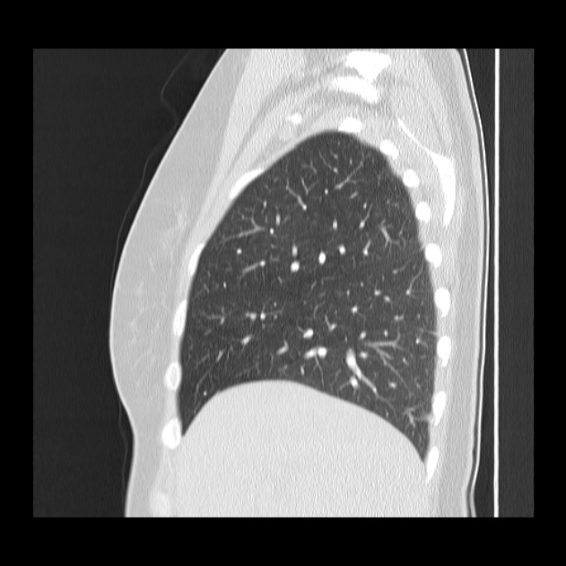 Bronchial atresia (Radiopaedia 22965-22992 Sagittal lung window 43).jpg