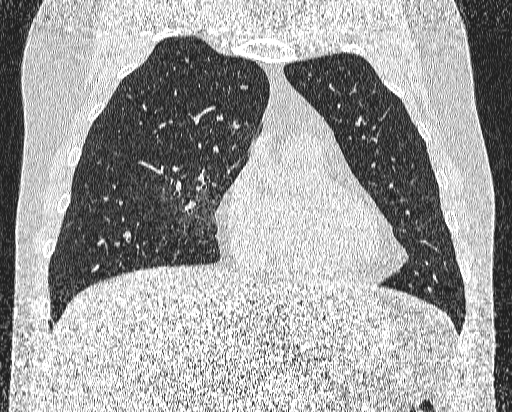 Bronchial atresia (Radiopaedia 58271-65417 Coronal lung window 16).jpg