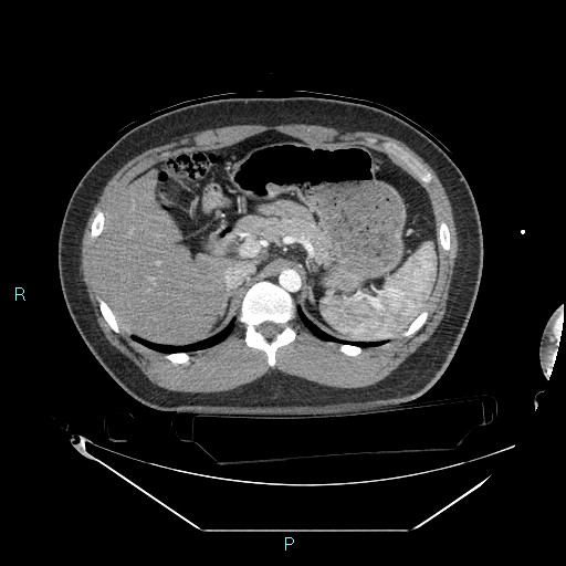 Bronchial carcinoid tumor (Radiopaedia 78272-90870 B 123).jpg