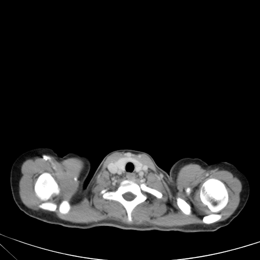 Bronchial mucoepidermoid carcinoma (Radiopaedia 57023-63895 Axial 5).jpg