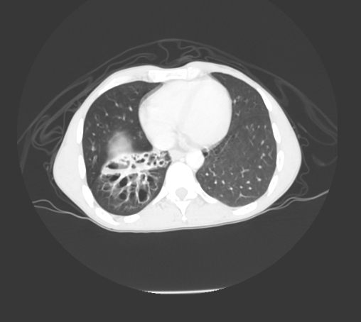 File:Bronchiectasis in Crohn disease (Radiopaedia 60311-67977 Axial lung window 11).jpg