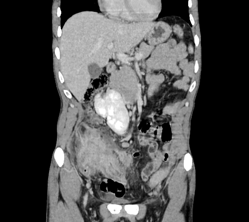 File:Bronchiectasis in Crohn disease (Radiopaedia 60311-67977 C 26).jpg