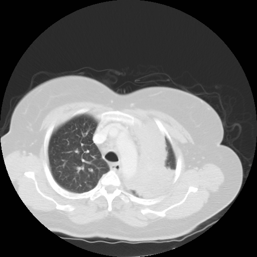 Bronchogenic carcinoma (Radiopaedia 73497-84262 Axial lung window 24).jpg