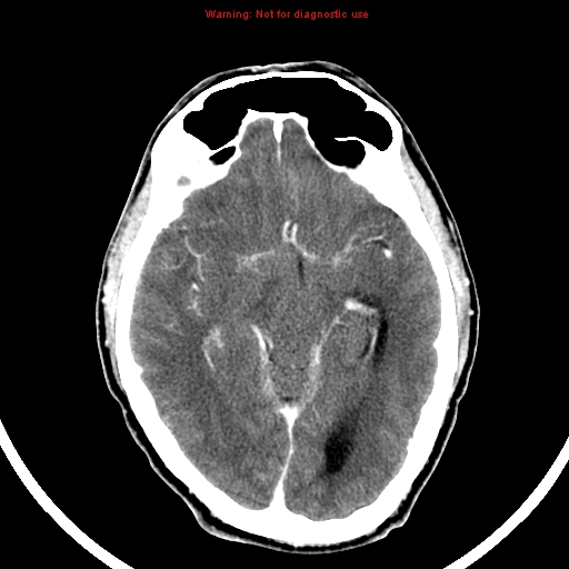File:Bronchogenic carcinoma brain metastasis (Radiopaedia 9286-9970 B 12).jpg